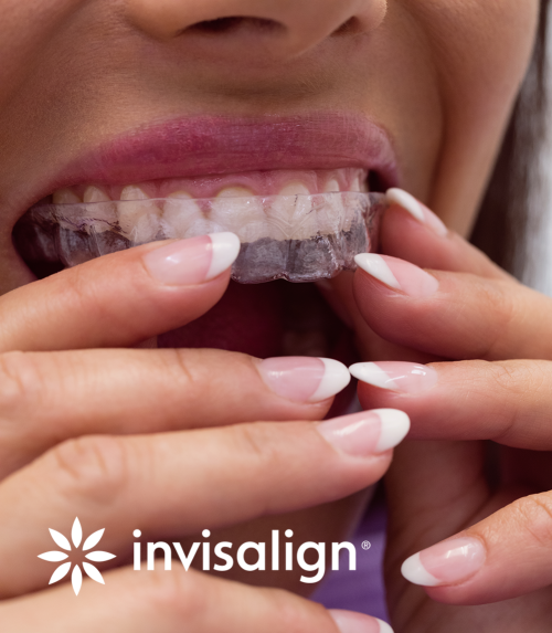 invisalign